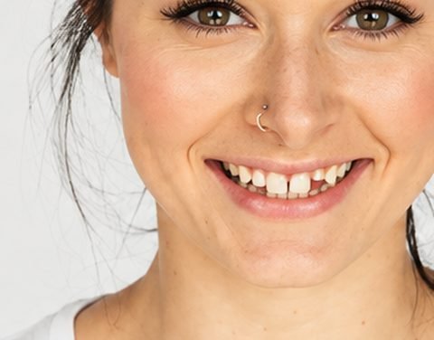 Smile before orthodontic treatment