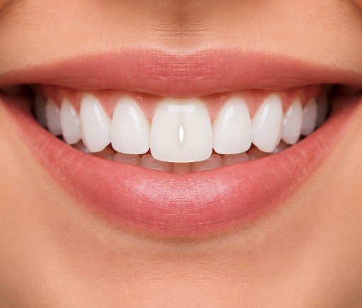 Bright, whitened smile after treatment