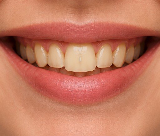 Duller teeth before whitening