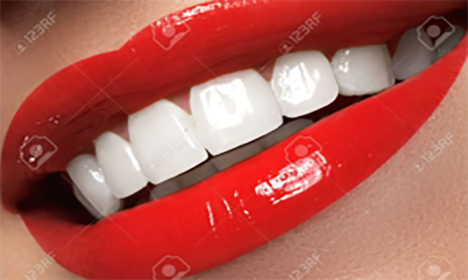 Hollywood Smile makeover