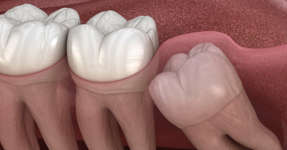 Wisdom tooth removal