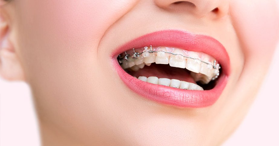 Invisalign clear aligners