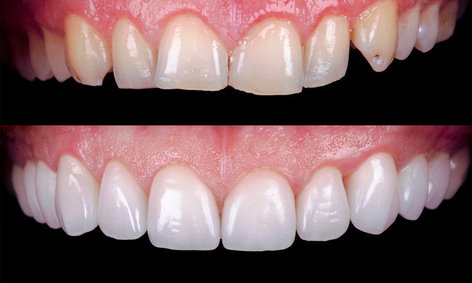 Cosmetic teeth bonding