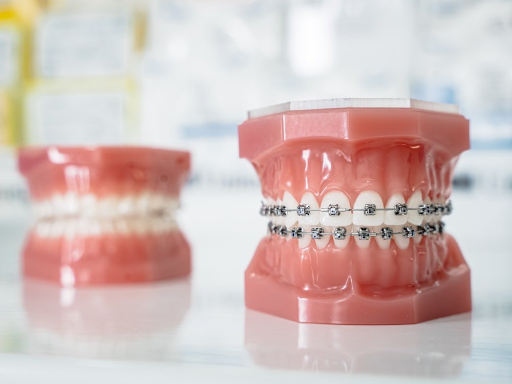 A dental model showing orthodontic braces