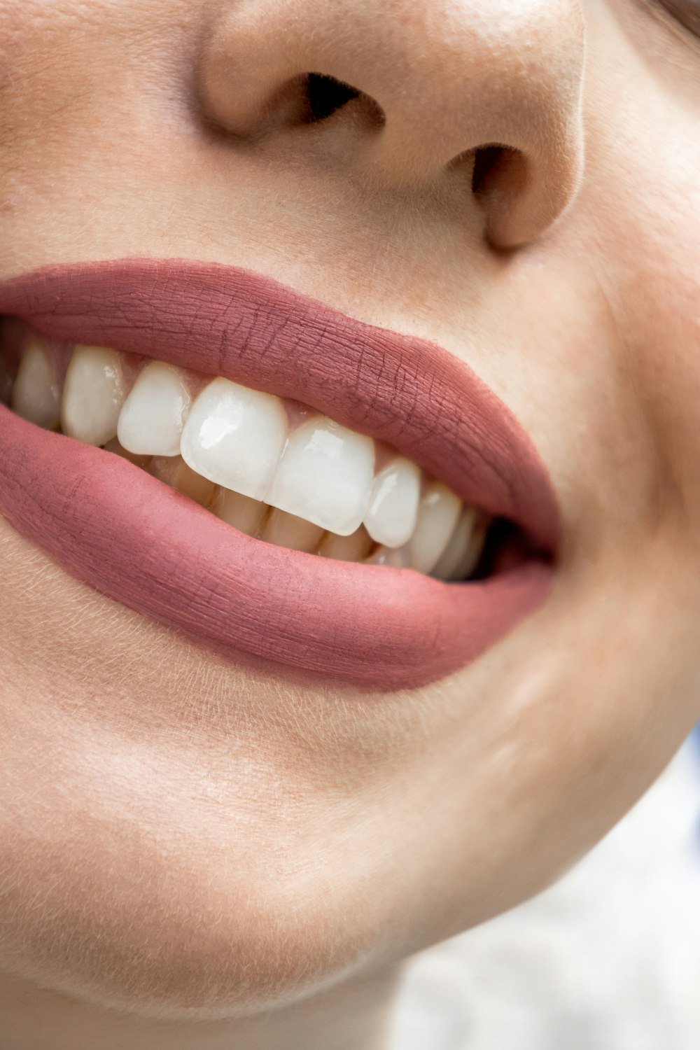 Dental veneers